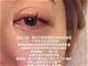 女演员王晴用微波炉煮蛋被炸伤眼睛